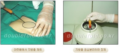 [DoubleFold Plastic Surgery Eye Surgery] - [Revision Surgery for Thick Double Eyelids] image 14