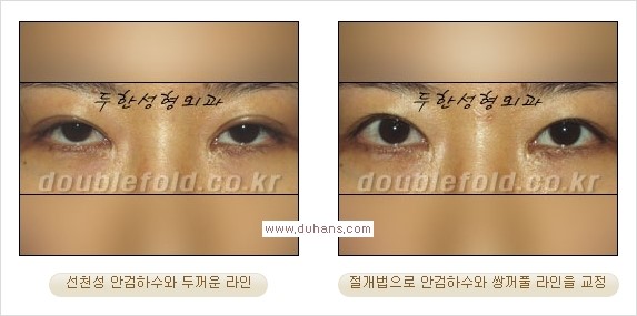 [두한성형외과 경쟁력 쌍꺼풀 재수술, 극한 눈재수술] - [안검하수 검사 및 수술방법 안내] 관련 이미지 13