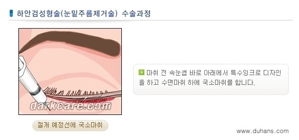 ​[두한성형외과 NO.1 다크써클 교정] - [하안검 성형술 + 눈밑지방 재배치] 관련 이미지 4