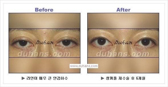 [두한성형외과 경쟁력 눈성형] - [안검하수(졸리운 눈매)의 종류와 교정 방법 안내] 관련 이미지 15