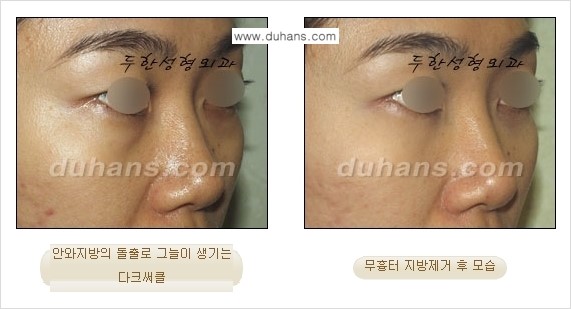 [두한성형외과 젊은 눈매 안검성형] - [눈밑 지방제거의 수술 전후 안내 ②] 관련 이미지 5