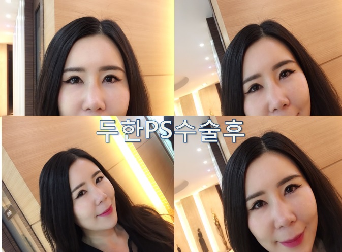 [두한성형외과-쌍꺼풀재수술 & 이마,팔자,눈밑,인디언밴드 지방이식] 관련 이미지 2