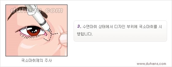 [두한성형외과 경쟁력 눈성형] - [흉터없는 몽고주름 제거 - 앞트임 수술 안내] 관련 이미지 11