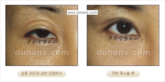 ⁠⁠⁠⁠[두한성형외과 성형 FOCUS] - [정상적인 눈매로의 복원 극한재수술 경우 ①] 관련 이미지 2