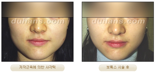 [두한성형외과 보톡스시술] - [사각턱 보톡스 안내] 관련 이미지 3