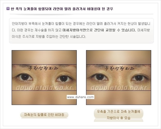 [두한성형외과 경쟁력 쌍꺼풀 재수술] - [짝짝이(비대칭) 쌍꺼풀 라인 교정하는 방법 안내 2.] 관련 이미지 7