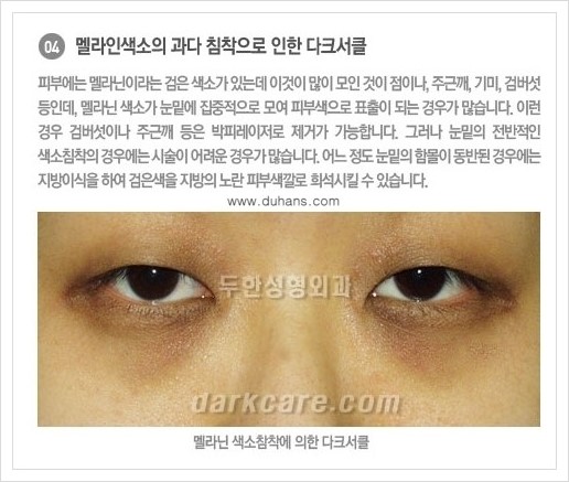 [두한성형외과 경쟁력 눈밑성형] - [다크써클의 종류] 관련 이미지 5