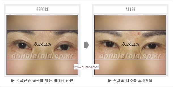 [두한성형외과 경쟁력 눈성형] - [비대칭 쌍꺼풀 라인의 교정방법 안내] 관련 이미지 14