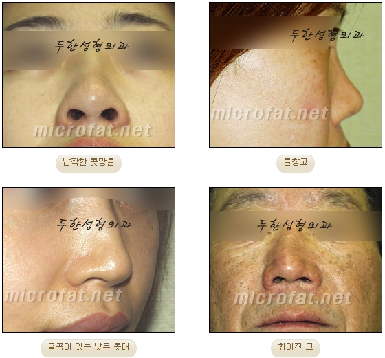 [Duhan Plastic Surgery Facial Fat Grafting] - [Fat Grafting Rhinoplasty] image 3