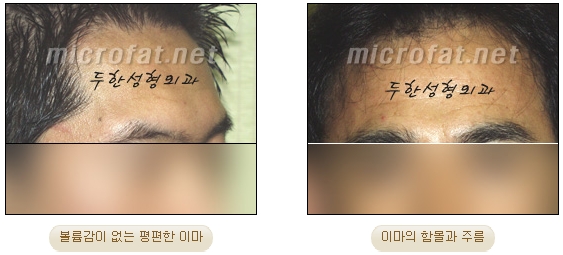 이마성형 두한성형외과 - 이마주름, 이마지방이식 관련 이미지 3