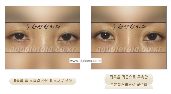 [두한성형외과 경쟁력 쌍꺼풀 재수술] - [비대칭(짝짝이) 쌍꺼풀 라인 교정하는 방법 안내 ①] 관련 이미지 4