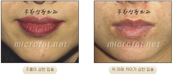 [Duhan Plastic Surgery Lip Surgery] - [Lip Correction Fat Grafting] image 3