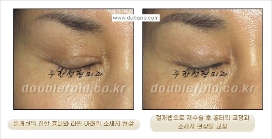 [두한성형외과 경쟁력 눈성형] - [쌍꺼풀 재수술 대상과 재수술의 문제점, 미운쌍꺼풀, 재수술 방법들] 관련 이미지 79