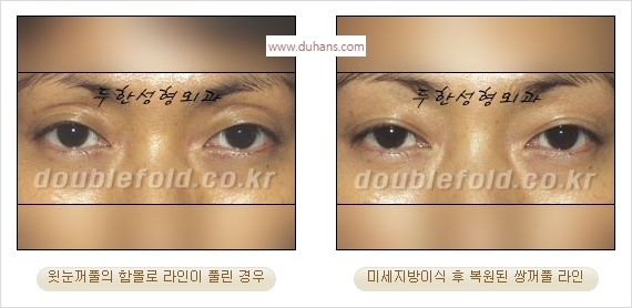 [두한성형외과 경쟁력 눈성형] - [풀려버린 쌍꺼풀 교정 방법] 관련 이미지 11