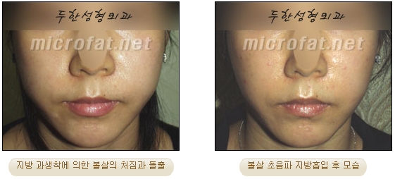 [Duhan Plastic Surgery Liposuction] - [Facial Liposuction] image 32