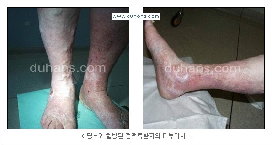 [두한성형외과 경쟁력 정맥류 치료] - [정맥류와 정맥확장증의 문제점 안내] 관련 이미지 1