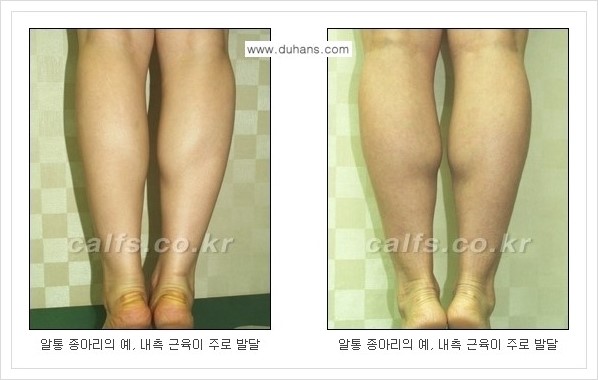 [두한성형외과 경쟁력 멀티종아리성형] - [나에게 맞는 종아리성형 방법의 종류 안내 1.] 관련 이미지 3