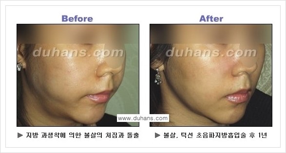 [두한성형외과 경쟁력 지방흡입] - [볼살지방흡입 안내] 관련 이미지 8