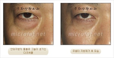 두한성형외과 눈밑수술 - 다크서클 수술 전후 관리 안내 관련 이미지 73