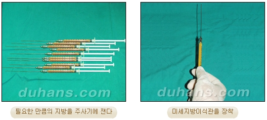 [Duhan Plastic Surgery Micro Fat Grafting] - [Receded Chin, Small Chin, Cleft Chin, Chin Line Asymmetry Correction] image 8