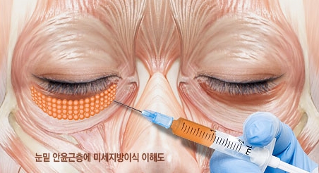 [두한성형외과 다크서클] - [콜펫지방이식] 관련 이미지 13