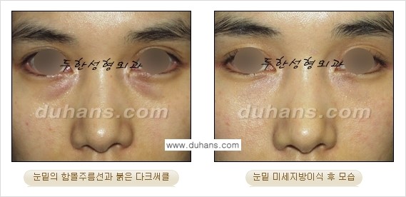 [두한성형외과 FOCUS 눈밑성형] - [다크써클의 치료방법 -  콜펫(Col-fat) 눈밑 미세지방이식 ⑤] 관련 이미지 9