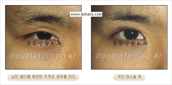 [두한성형외과 경쟁력 쌍꺼풀 재수술, 극한 눈재수술] - [망가진 쌍꺼풀 라인을 교정하는 극한 재수술을  위한 계획] 관련 이미지 12