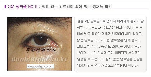 [두한성형외과 경쟁력 눈성형] - [미운 쌍꺼풀이란?] 관련 이미지 12