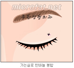 [두한성형외과 지방제거] - [눈밑지방제거, 윗눈꺼풀지방제거] 관련 이미지 59