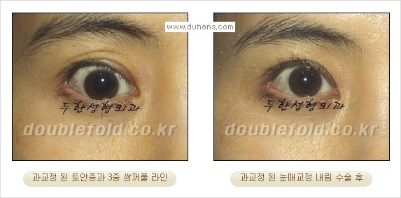 ⁠⁠[두한성형외과 경쟁력 쌍꺼풀 재수술] - [재수술 대상과 재수술의 문제점] 관련 이미지 18