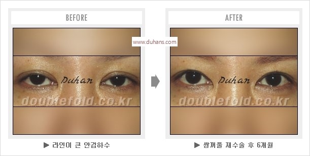 [두한성형외과 경쟁력 눈성형] - [나에게 맞는 어울리는 쌍꺼풀 라인] 관련 이미지 12