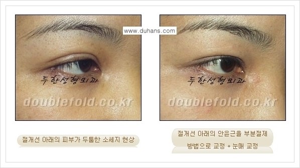 [두한성형외과 경쟁력 쌍꺼풀 재수술, 극한 재수술] - [쌍꺼풀 절개선 아래가 두툼한 소세지 쌍꺼풀의 교정 안내] 관련 이미지 6