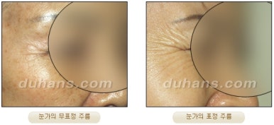 [Duhan Plastic Surgery Wrinkle Improvement] - [Wrinkle Lifting] image 3