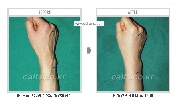 ⁠⁠[두한성형외과 정맥류 치료] - [손, 팔 정맥확장증 사진자료 안내 ②] 관련 이미지 6