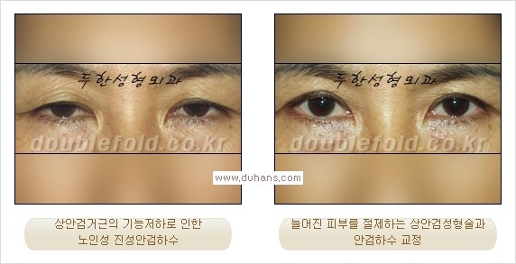 [두한성형외과 경쟁력 쌍꺼풀 재수술, 극한 눈재수술] - [안검하수(졸린 눈매)의 종류 안내] 관련 이미지 7