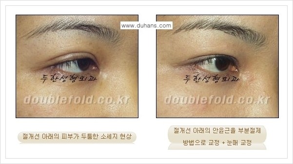 [두한성형외과 경쟁력 쌍꺼풀 재수술, 극한 재수술] - [절개선 아래가 두툼한 소세지 쌍꺼풀의 교정 안내] 관련 이미지 2