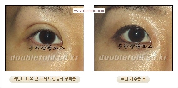 [두한성형외과 경쟁력 쌍꺼풀 재수술] - [피부 여유분이 부족해서 토안증이 발생한 경우 극한 재수술] 관련 이미지 7