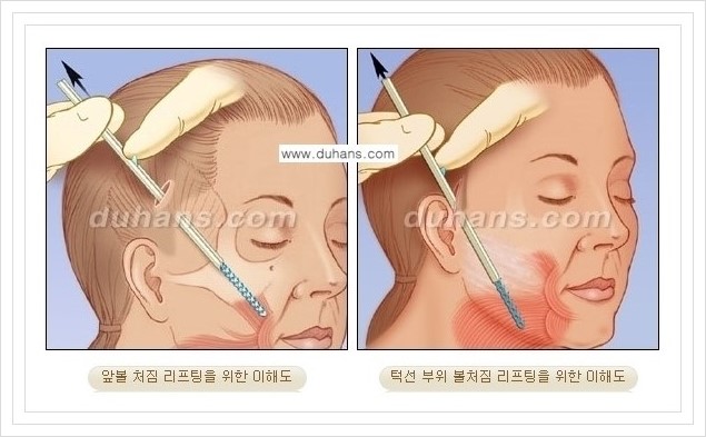 [두한성형외과 경쟁력 주름성형] - [볼처짐 개선, 이마주름 개선을 위한 엔도타인 리프팅 안내] 관련 이미지 7