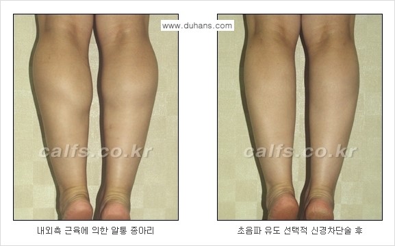 ​[두한성형외과와 날씬한 종아리 만들기!] - [간편하고 안전한 종아리 축소방법 ④] 관련 이미지 8