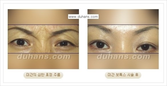 [두한성형외과 경쟁력 주름교정] - [간단 주사요법 - 보톡스 시술 안내 ②] 관련 이미지 3