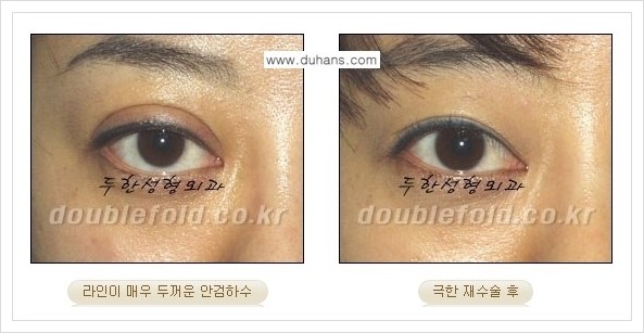 [두한성형외과 경쟁력 쌍꺼풀 재수술] - [극한의 상태에서 쌍꺼풀 재수술 안내 ②] 관련 이미지 5