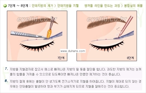 [두한성형외과 경쟁력 눈성형] - [퀵쌍꺼풀(부분절개법) 수술 안내] 관련 이미지 15