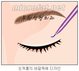 [두한성형외과 지방제거] - [눈밑지방제거, 윗눈꺼풀지방제거] 관련 이미지 53