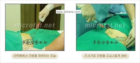 ​[두한성형외과 경쟁력 지방이식] - [지방이식 부작용 이후 마이크로 지방흡입, 마이크로 지방흡입 이후 부작용 없는 지방이식 방법] 관련 이미지 11