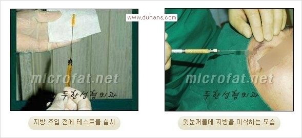 [두한성형외과 경쟁력 쌍꺼풀 재수술] - [삼중(세겹) 쌍꺼풀 라인, 눈꺼풀이 함몰된 삼중(세겹) 쌍꺼풀 라인 교정] 관련 이미지 13