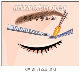 [두한성형외과 지방제거] - [눈밑지방제거, 윗눈꺼풀지방제거] 관련 이미지 57