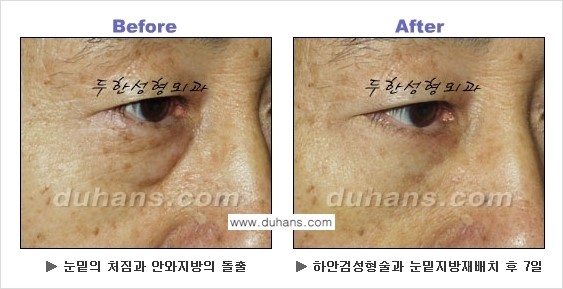 [두한성형외과의 상큼하고 환한 젊은 눈매완성] - [하안검 성형술 ②] 관련 이미지 17