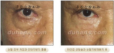 Blepharoplasty, Duhan Plastic Surgery - Upper and Lower Eyelids image 26