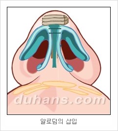 DuHan Plastic Surgery Revision Rhinoplasty - AlloDerm Nose Surgery, SureDerm Nose Surgery image 11
