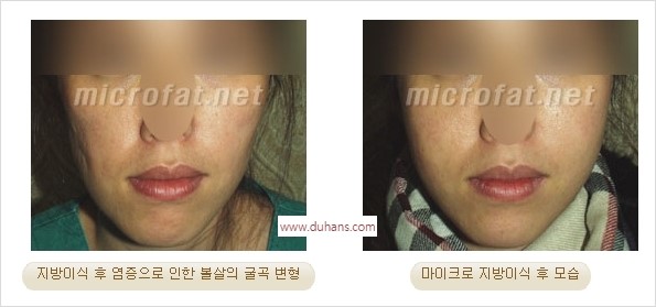 [두한성형외과 경쟁력 미세지방이식] - [지방이식 부작용 교정 모습 안내] 관련 이미지 19